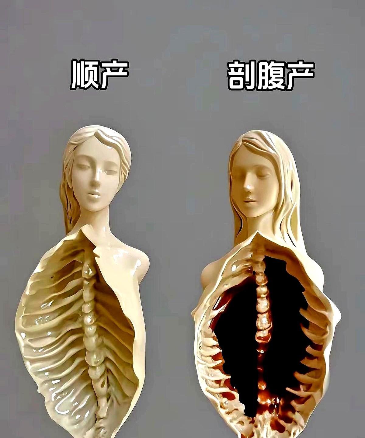 孕妈必看！顺产or剖腹产